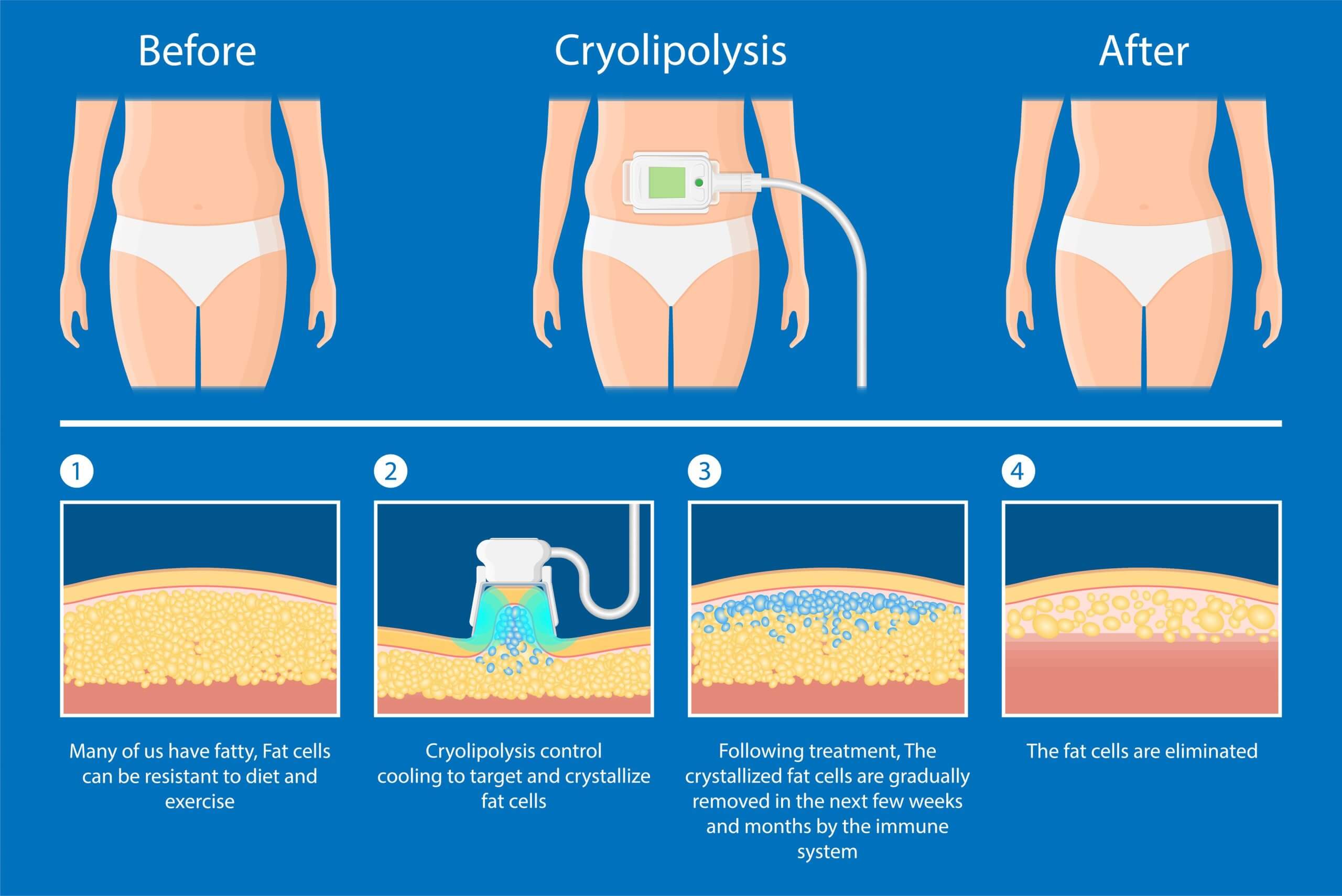 diagram of the process of coolsculpting body contouring in chicago